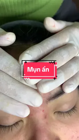 Tác hại của việc mua thuốc bôi trị mụn trên mạng #dieutridakhoahoc #nanmunchuanykhoa #nanmunchuanykhoa #nanmun #nanmunbangtay #xuhuong #fypシ゚ #fyp #mesotherapy #pellda 