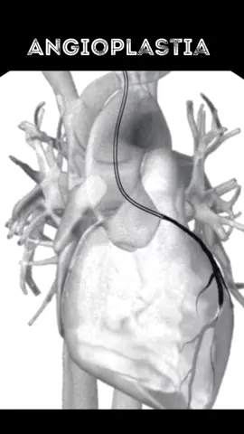 A angioplastia coronariana, também conhecida como intervenção coronariana percutânea (ICP), é um procedimento médico utilizado para abrir artérias coronárias estreitadas ou bloqueadas. Essas artérias fornecem sangue ao coração, e o estreitamento ou bloqueio pode causar dor no peito (angina) ou um ataque cardíaco. O procedimento de angioplastia geralmente envolve os seguintes passos: 1. Inserção do Cateter: Um cateter (um tubo fino e flexível) é inserido em uma artéria, geralmente na virilha ou no braço, e guiado até as artérias coronárias. 2. Inflação do Balão: Uma vez que o cateter está posicionado na área estreitada ou bloqueada da artéria coronária, um balão na ponta do cateter é inflado. Isso expande a artéria, esmagando a placa de gordura contra as paredes da artéria e restaurando o fluxo sanguíneo. 3. Colocação do Stent: Em muitos casos, um stent (um pequeno tubo de malha de metal) é colocado na artéria para mantê-la aberta após a remoção do balão. O stent pode ser revestido com medicação para ajudar a evitar a formação de novas obstruções. A angioplastia coronariana é frequentemente realizada para aliviar sintomas de angina, melhorar o fluxo sanguíneo para o coração e reduzir o risco de ataque cardíaco. A recuperação geralmente é rápida, e muitos pacientes podem retornar às suas atividades normais em poucos dias. No entanto, como qualquer procedimento médico, a angioplastia coronariana tem riscos, como sangramento, infecção, reações alérgicas aos materiais utilizados e, raramente, complicações graves como ataque cardíaco ou acidente vascular cerebral. #angioplastiacoronaria #fisio #angioplastia #fisioterapia #angioplasty #enfermagem #medical #cardio #fh♿️ 