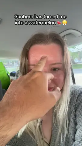 Im so swollen omg  #sunburn #sunpoisoning #wearyoursunscreen #fyp 