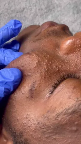 Clogged pores? Book a session with us.  Find us on instagram @danzartistry.  #jamaicatiktoker🇯🇲 #skintok #estheticianlife #clearskintips #waxvideos #facialtime ##esthetician #jamaicantiktoker🇯🇲🇯🇲 #pimplepopperaddict #pimple #fypage #skintok #jamaicatiktok 