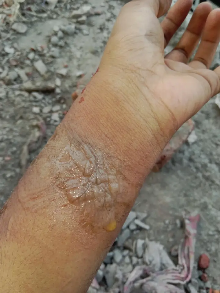 আমার পাগলি টার হাত পুড়ে গেছে 😥😥 সবাই দোয়া করবেন 😥😥😥😥