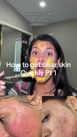 How to Get Clear Skin Quickly 🫶🏼 #creatorsearchinsights #acneproneskincare #turmericmask