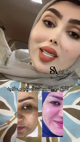 للحجز والاستفسار التواصل مع شمس الامير على الواتساب فقط ⤵️  ٠٧٧١٤٣١٤٣٩٩  احجو مشكله بشرتكم و راح ننصحكم بالمنتج المناسب و ضمان النتيجه اكيد #براند_شمس_الامير اول براند عراقي منتجات تجميل من الاعشاب صنع لبنان  عنوان بصره الطويسة شارع اللجنة الاولمبية مقابل فروج ابو العبد  #براند_شمس_الامير #هدى_يوسف #الشعب_الصيني_ماله_حل😂😂 #اكسبلور #شمس_الامير #tiktokindia #tik #trending #تبيض #يارب #شد_الاجفان #عناية_بالبشرة #explore #تصبغات #العراق #اكسبلورexplore #منتجات #تبيض #هدى_يوسف 