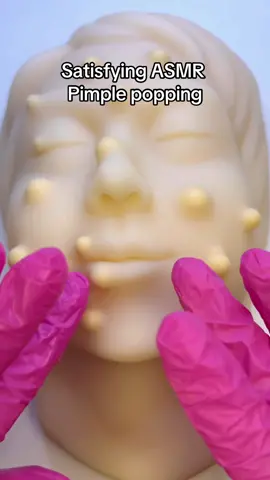 Satisfying ASMR pimple popping! #asmr #asmrsounds #fyp #satisfying #relax #skincare #acne #mochipimplepopping #viral #asmrtingles #nostalgia 