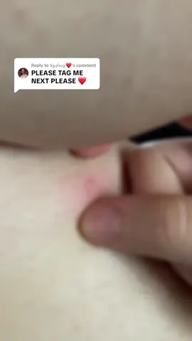 Replying to @𝒮𝓎𝒹𝓃𝑒𝓎❤️  who wants to he tagged next? #pimple #pimples #pop #fy #satisfying 