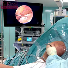 Left Shoulder Arthroscopy (Keyhole) Surgery, with Rotator Cuff Repair, in a Power Lifter, Performed by Dr Kandil. A rotator cuff tear is a common cause of shoulder pain and disability among adults. A torn rotator cuff may weaken your shoulder. This means that many daily activities, like combing your hair or getting dressed, may become painful and difficult to do. During an arthroscopic rotator cuff repair, your surgeon inserts a small camera, called an arthroscope, into your shoulder joint. The camera displays pictures on a television screen, and your surgeon uses these images to guide miniature surgical instruments. Surgery to repair a torn rotator cuff most often involves re-attaching the tendon to the head of humerus (upper arm bone). “All that glitters is not gold” ~ William Shakespear 