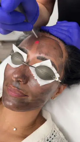 Carbon peel for this beautiful client 😍 #carbonpeel#hollywoodpeel#laser#hydrafacial#facial