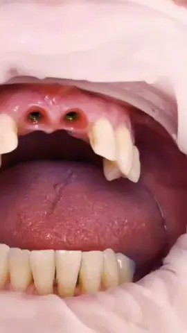 IMPLANTS UPPER CENTRAL INCISORS 🦷🩺    (Implantation) DENTO HISMILEE  DAILY UPDATE ABOUT DENTISTRY       📋🪥💊🩺🦷 #DOCTORS #DENTIST #DENTISTRY #dentistryworld #toothpain #dentallove #tiktokteamviralmyvideo #tiktokteamviralmyvideo #viral #foryou #viral #foryou #viral #foryou #foryou 