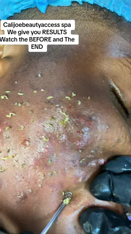 #calijoebeautyspa #calijoebeautyaccess #calijoespa #acnetreatment #asmrsounds #lagostiktok #pimpleremover #pimple #popper #blackheads #blackheadsremoval #calijoebeautyspa 
