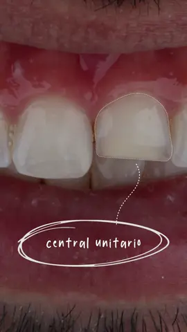 🔍 Bem-vindos ao Episódio 1 dos nossos Relatos de Caso Odontológicos! Hoje, vamos transformar um sorriso com a criação de um central unitário. 🦷✨ #Odontologia #CasoClínico #CentralUnitário #Dentista #EstudantesOdonto #relatodecaso #vidadedentista #resinacomposta  🎥 Quer saber como? Assista ao vídeo completo e veja o passo a passo dessa incrível transformação! 👇 🔔 Não perca os próximos episódios - siga para mais casos clínicos! 🫶🏻💛