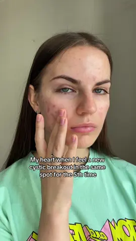 Recurring pimple team🙋🏻‍♀️ My Instagram: veronavlkv #skin #acne #acneproneskin #skincare #pimple #cysticacne #acnefighter  