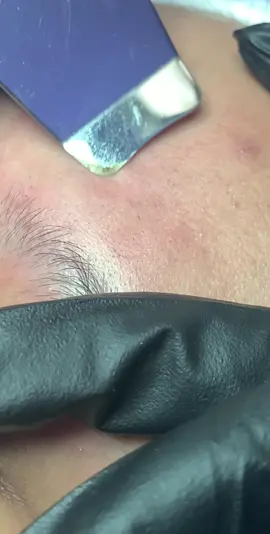 Facial srubber with ultrasonic vibrations help ease out impurities ✨ #skinextractions #extractions #foryoupage #fyp #asmr #visualasmr #skincare 