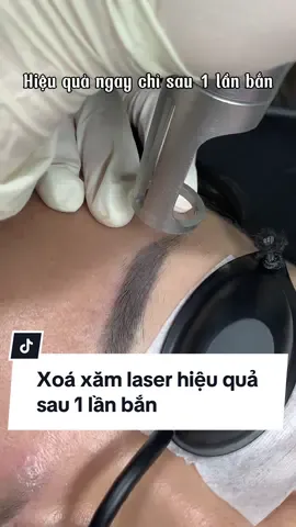 Xoá xăm lông mày bằng laser tại Natalie hiệu quả ngay sau 1 lần bắn. Nhanh tay đăng ký trải nghiệm với giá 999k nhé các bạn! #xoaxamlaserpico #xoaxamlaser #sualongmay #xoaxamlongmay #nataliebeauty 