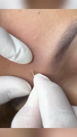 #pimple #blackheads 