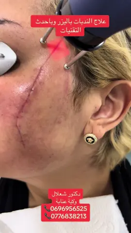 #cliniceldhia #drchaallel #laser #esthetique #ليزر #تجميل #علاج #traitement #cicatrices #ندبات #ندبات_حب_الشباب #ندبات_جراحية #ندبات_الوجه #algerie #algerie🇩🇿 #annaba #annaba23 #annaba❤ #soukahras #guelma #skikda #oran #oran31 
