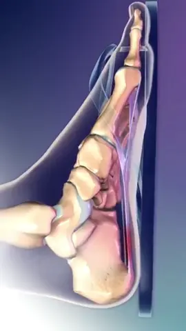 A fascite plantar é uma inflamação da fáscia plantar, um tecido espesso que corre ao longo da sola do pé, conectando o osso do calcanhar aos dedos.  Causas - Sobrecarga do pé, como ficar em pé por longos períodos. - Uso de calçados inadequados. - Pé plano ou arco alto. - Aumento súbito na atividade física. Sintomas - Dor no calcanhar ou na parte inferior do pé, especialmente ao dar os primeiros passos pela manhã ou após longos períodos de descanso. - Rigidez no pé. Tratamento - Descanso e gelo: Para reduzir a inflamação. - Exercícios de alongamento: Para a fáscia plantar e os músculos da panturrilha. - Uso de palmilhas ortopédicas: Para suportar o arco do pé. - Medicamentos anti-inflamatórios: Para aliviar a dor. - Fisioterapia: Para fortalecer e alongar a área afetada. - Uso de calçados adequados: Com bom suporte e amortecimento. Prevenção - Exercícios regulares de alongamento:  - Uso de calçados apropriados: para a atividade e o tipo de pé. - Controle do peso corporal: para reduzir a pressão nos pés. A fascite plantar pode ser tratada eficazmente com medidas conservadoras, mas pode exigir várias semanas ou meses para uma recuperação completa. #fasciteplantar #fisioterapia #fisioterapeuta #calcaneo #fasceiteplantar #fisio #anatomia #fr♿️ 