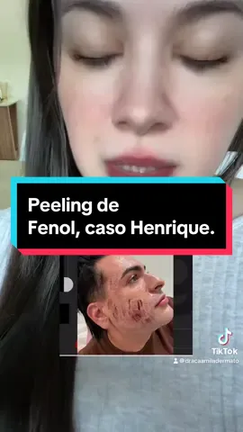 #peeling #peelingfenol #fenol #noticias #dicas #BeautyTok #dermatologo #dermatologia #medicina #estetica #rugas #envelhecimento #fyp 