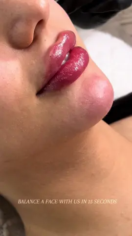 when everything comes together perfectly 💉😍 #facialbalancing #filler #miami