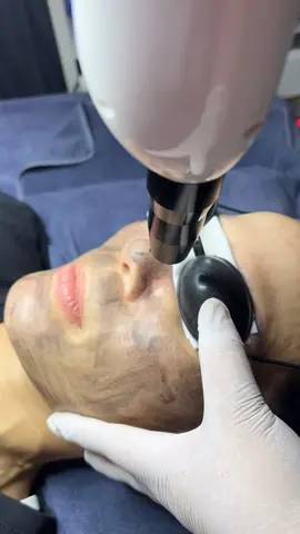 #thinhhanh  Laser Cacbon có tác dụng gì ?  #xuhuong #viral 