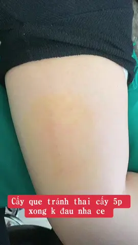 Cấy que tránh thai tại nhật .. nhận lm tại nhà vs khách tỉnh xa ạ #cayquetranhthainhatban #cayquetranhthai #tranhthaitainhat 