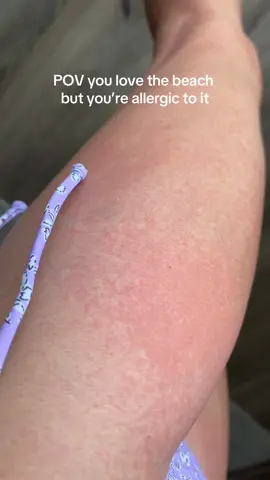 Any dermatologists out here? Happens as soon as my feet hit the sand and stays until i leave.  It Itches and stings and has been  happening since i was little.  Anyone else? #miserable #fyp #foryou #foryoupage #beach #allergic #whatisthis #sand #sun #dermatology 