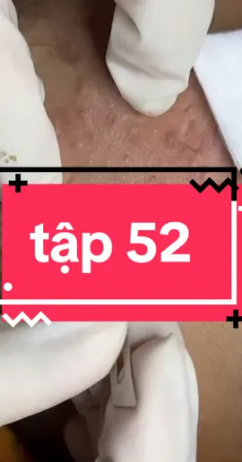 trị mụn bến tre #nguyenchuyenmun #trịmụn #binhdaibentre #laymunbangtay 