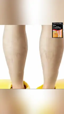 Varicose vein patch relief #varicoseveins #fyp #tiktokshop 