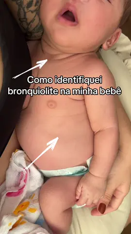 Quase impossivel escapar desses virus gripais #bronquiolite #bronquioliteembebê 