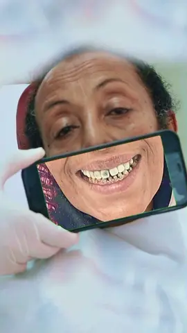 Zirconia crowns  #fyp #ethiopian_tik_tok #Dentist #Nash #viral 