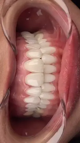 Zirconium Veneers ✨ ✔️Your treatment will be completed in 5 days ✔️Dentist Consultation -Free ✔️Panoramik x-ray - Free ✔️Temporary Crowns during treatments - Free ✔️Removal of old Crowns - Free ✔️Medicine and Accompaniment - Free  . . . . . . . . . . #crowns #dentalhealth #newsmile #whitening  #perfectsmile #whiteteeth #emaxveneers #dentalart #dentalcrowns 