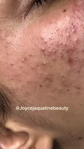 Oi 🤭 #satisfyingvideo #pimple #esteticafacial #videosatisfatorio #cravo #poppingpimples #satisfying #tirandocravo 
