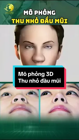 Mô phỏng thu nhỏ đầu mũi #drchieu #nangmui #chuyensaunangmui #nangmuicautruc #xuhuong #drchieunangmui #pttm #muigo 