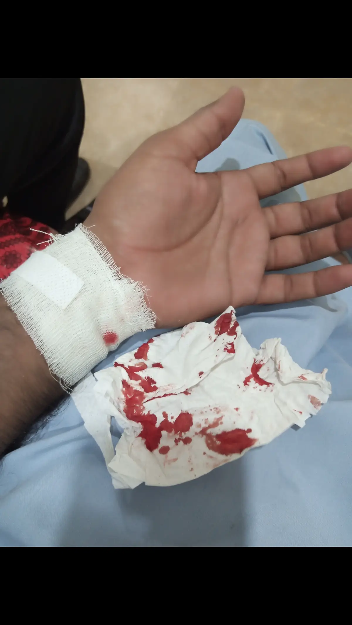 #aj mery hand pas chot lag gai kafi balding hui B's ❣️❣️❣️❣️#foryou #foryourpage main ne Socha Chalo video tik py dal dety Hain viral to honi nahi hai phir b shayd ho jay