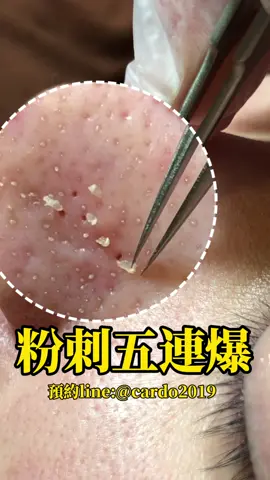 ⚠️預約line：@cardo2019⚠️ Cardo skin care 預約服務分店 #現在課程有買一送一優惠 新莊總店｜新店店｜圓山店｜蘆洲店 中和店｜林口店｜中壢店｜汐止店｜景美店 #美容保養 #美容 #保養 #粉刺 #痘痘 #做臉 #台北 #cardo #林口 #三重清粉刺 #泰山做臉 #龜山做臉 #新莊做臉 #新莊清粉刺 #林口清粉刺 #迴龍清粉刺 #樹林清粉刺 #蘆洲清粉刺 #黑眼圈 #丹鳳做臉 #男生做臉 #男生清粉刺 #男生保養 #新莊護膚 #台北護膚 #婚前保養 #耳燭 #美容教學 