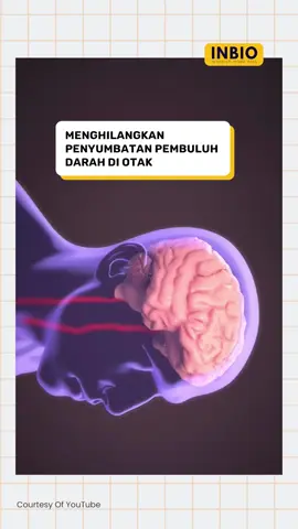 Menghilangkan penyumbatan pembuluh darah di otak