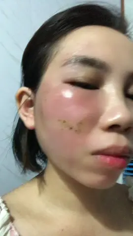 Bầu bị zona kiểu gì mà xưng biến dạng cả mặt ntn các mom ơi 😭😭😭😭 ngứa mà chẳng biết làm sao#zonathankinh #mebau #trending 