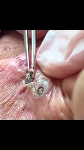 Olha esse cravo atras da ouvido 😱 #orelha #ouvido #orelhas #cera #cer #remocao #cravos #cravo #impressionante #satisfatorio 