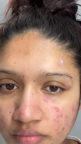 Juicy Pimple patch peel off 🌟  #pimplepatch #pimplepatchremoval #peeling #acne #acnepatch #acneproneskin #cysticacne #juicypimple #pimple #pimplepatches 
