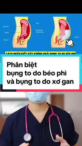 bác nào hay uống bia rượu mà bụng to thì chú ý nhé #baove #Gan #tangcuongchucnanggan #hotro #viemgan #sơgan #mengancao #gannhiemmo #lanuonggiaidocgan #nhangiaidocgan #suckhoe #xh #xhtiktok #xuhong #fyp #video #videoviral 
