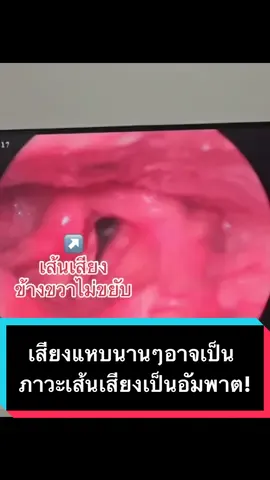 เสียงแหบนานๆที้ไม่หาย อาจเกิดจากภาวะเส้นเสียงเป็นอัมพาต!! #พิกัดลับกรุงเทพ #หมอเปย่า #คลินิกล้างหู #พี่หมอเปย่าหูคอจมูก #รู้จากtiktok #tiktokuni #เดอคีนคลินิค #สอนให้รู้ว่า #คีนท์คลินิกหูคอจมูกอารีย์ #คลินิกหูคอจมูกกทม #เส้นเสียงเป็นอัมพาต #เสียงแหบ #กล่องเสียงอักเสบ #vocalcorddysfunction #มะเร็งไทรอยด์ 