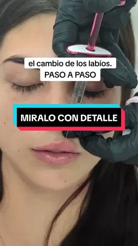 EL PROCESO DE AUMENTO DE LABIOS CON ÁCIDO HILAURÓNICO. Un proceso aparentemente sencillo pero que, está sujeto a varios aspectos para su definición y duración: 1) El ácido hialurónico utilizado. El laboratorio debe de ser de máxima confianza y seguridad. 2) La técnica de la doctora. Sin lugar a dudas, este es el aspecto fundamental. Apuesta por la seguridad, duración y calidad. #acidohialuronico #acidohialuronicolabios #russianlips #ibiza 