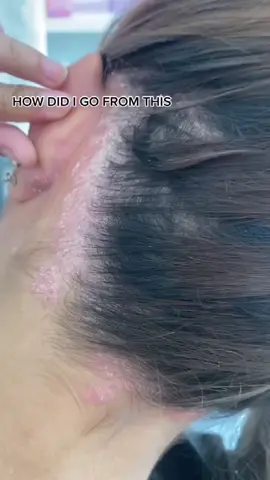 #shampooandconditioner #psoriasis #psoriasiswarrior
