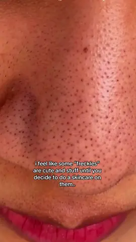 Are those freckles!?? 🙊 #fyp #foryou #skincaretips #skincare #blackheadsremoval #blackheads #SkinCare101 #facecare #glowskin #blackhead #skincaretiktok #skincareaddict #hygienetips  #hyginetips #facewash #skintok 