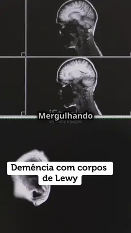 #demencia #neurology #geriatria #idosos #alzheimer #parkinson #Love #popularvideo #popular #medicina 