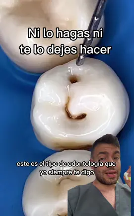 Las caries no las podemos seguir tratando como hace 50 años 😖 Hoy sabemos que no debemos ser tan invasivos, que no siempre hay que quitarla! 🦷 Se puede controlar 🧪 no siempre hay que sacrificar el diente para “desinfectarlo” 🦠🤔 #caries #restauracion #resina #calza #empaste #composite #odontologia #biomimetica 