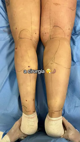 ANTES E DEPOIS  #cirurgialipedema #lipedema #cirurgia #posoperatorio 