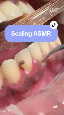 Scaling ASMR #klinikgigi #doktergigi #doktergigibandung #klinikgigibandung #karanggigi #skelinggigi 