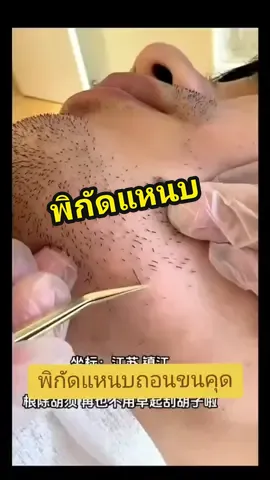 แหนบถอนขนคุด สิว เอนกประสงค์ กดเลยจ้า#เปิดการมองเห็นtiktok #ขายของออนไลน์ #ขายดีมากปังสุดๆ #แหนบถอนขนสแตนเลส 