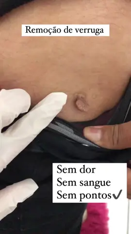 Remoção de verruga com eletrocauterio.✔️