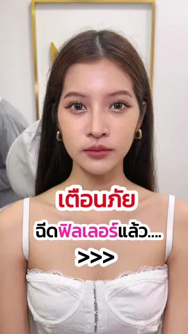สะดุ้งแรง รู้งี้…🫣#รีวิวบิวตี้ #titokป้ายยา #megaclinic #เมกะคลินิก #รีวิว #fypシ #fyp #tiktokบิวตี้ #ฟิลเลอร์ปาก #ฟิลเลอร์ปรับรูปหน้า 